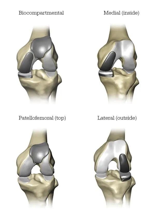 1 knee replacement